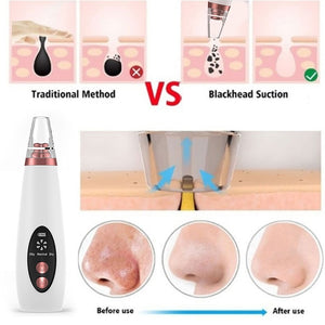 Acne/Blackhead Deep Cleaning Suction Vacuum