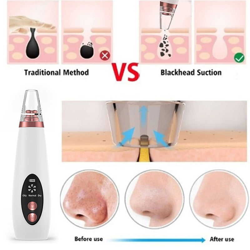 Acne/Blackhead Deep Cleaning Suction Vacuum