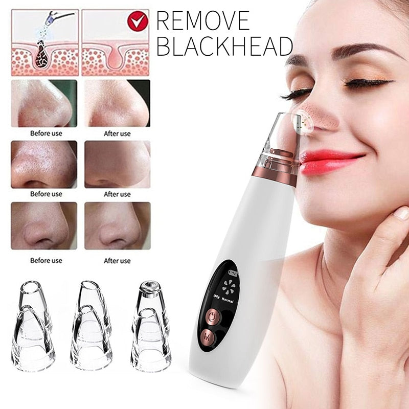 Acne/Blackhead Deep Cleaning Suction Vacuum