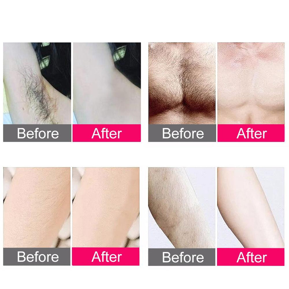 IPL Laser Hair Removal